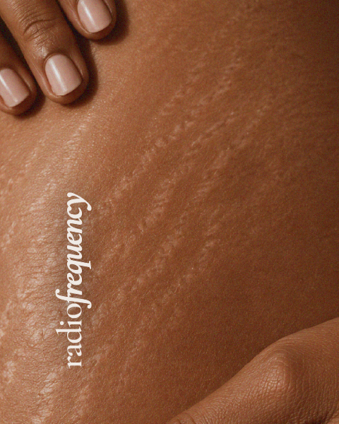dmdfusion-bedfordview-services_radio-frequency body sculpting and tightening